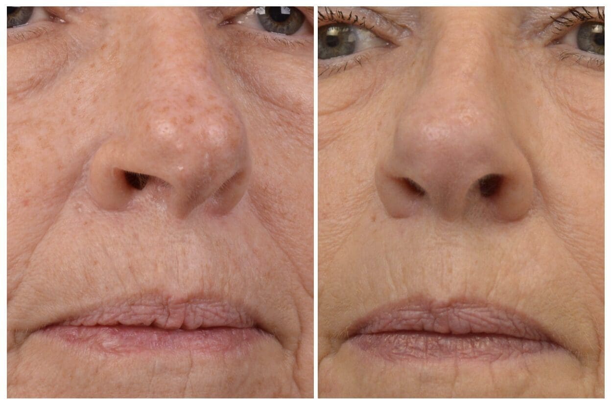 4 RF Microneedling with PRP, Erbium Treatment and Botox to DAO's