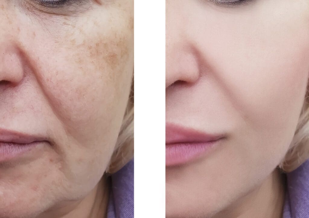 Before and after facial skin rejuvenation treatment
