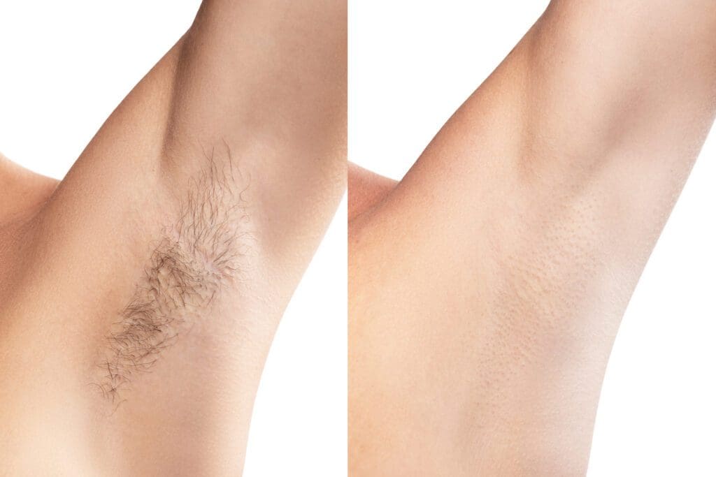 Laser Hair Removal Indianapolis