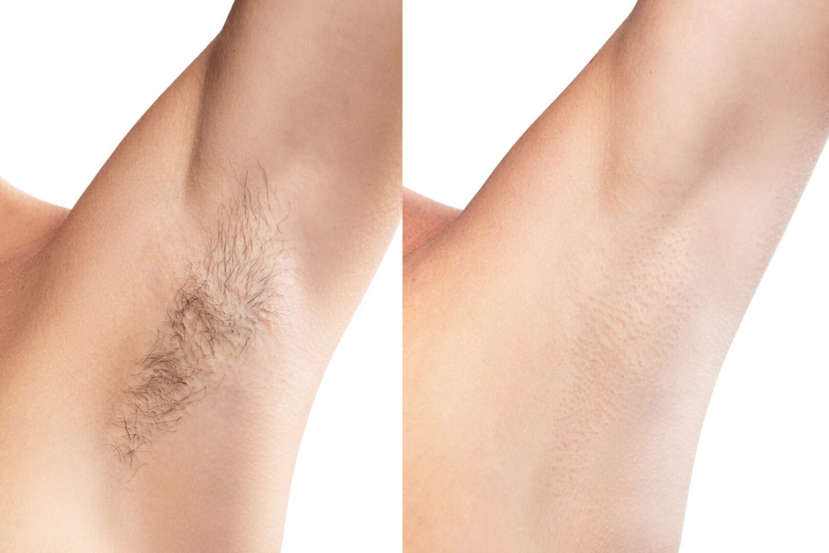 Before and after underarm hair removal