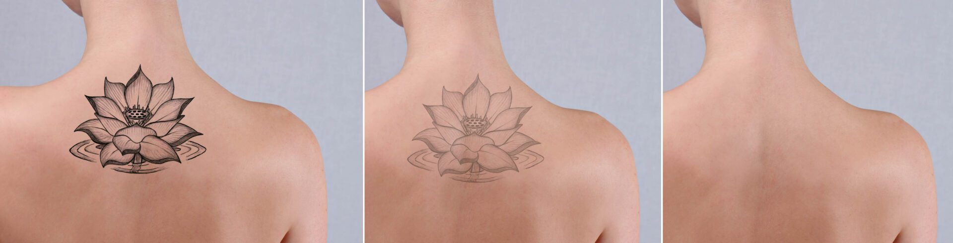 Lotus tattoo fading on upper back, three stages
