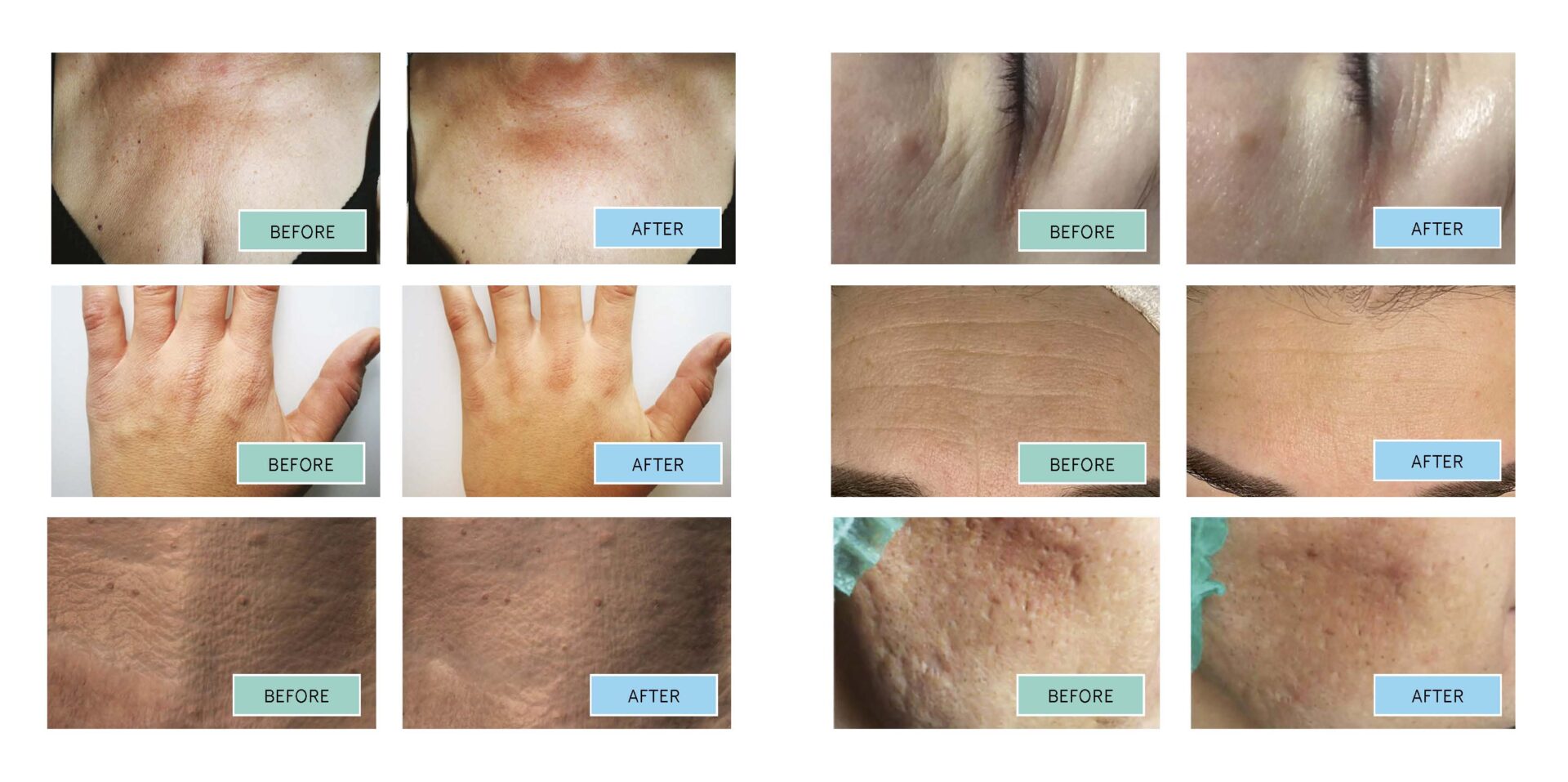 Before and after results of BioRePeelCl3 chemical peel treatment showing visible skin improvement
