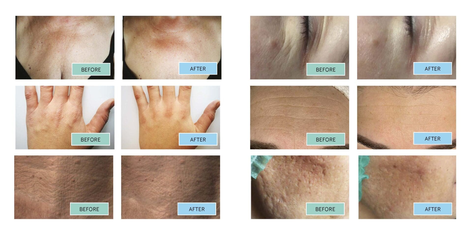 Before and after results of BioRePeelCl3 chemical peel treatment showing visible skin improvement