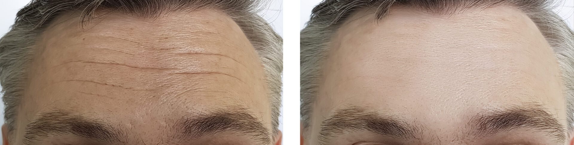 Xeomin Dysport Neuromodulator treatement before and after