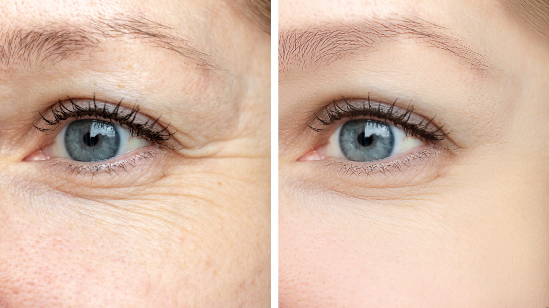 before and after botox dysport xeomin neuromodulator treatment