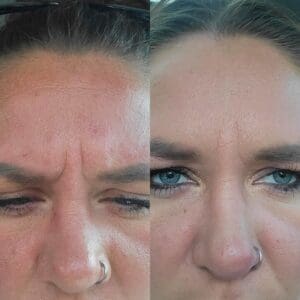 dysport xeomin before after