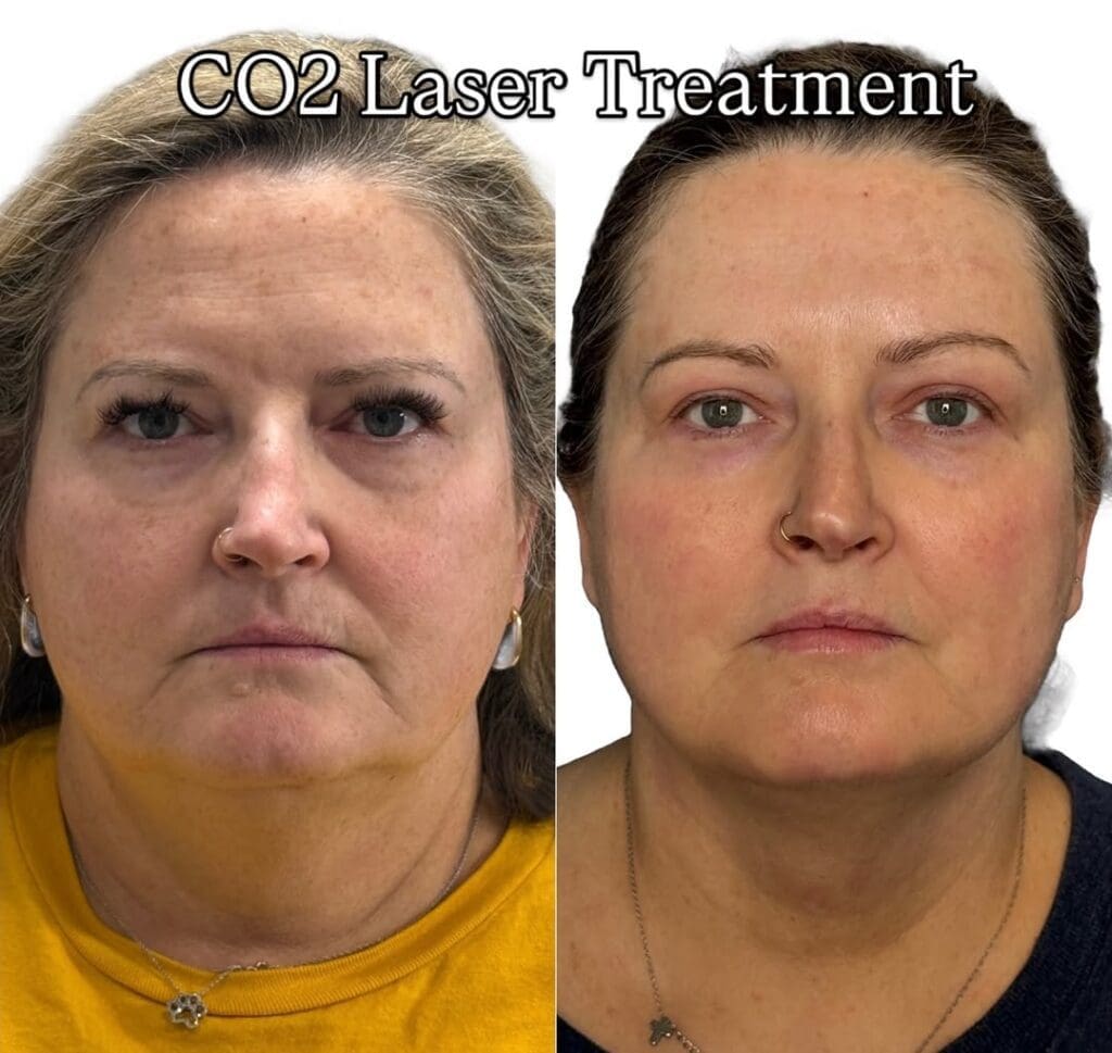 CO2 Laser Treatment Indianapolis