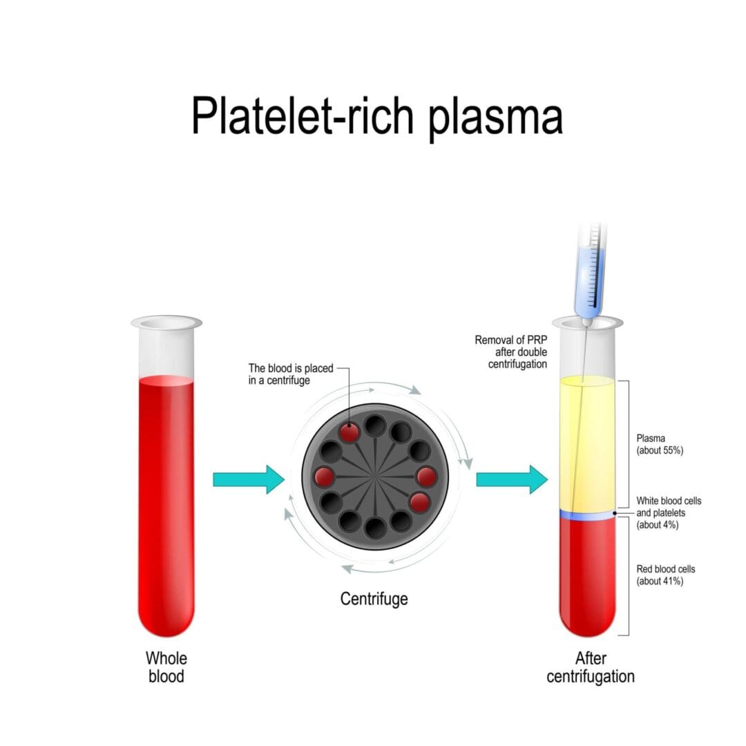 PRP Eye Treatments Indiana