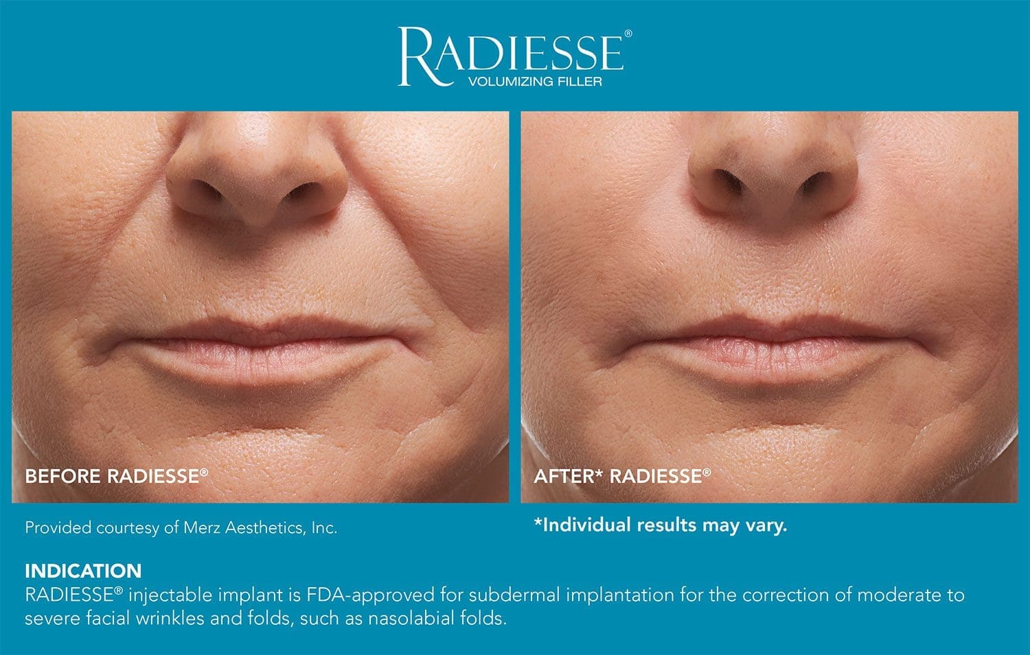 RadiesseBefore&After-0
