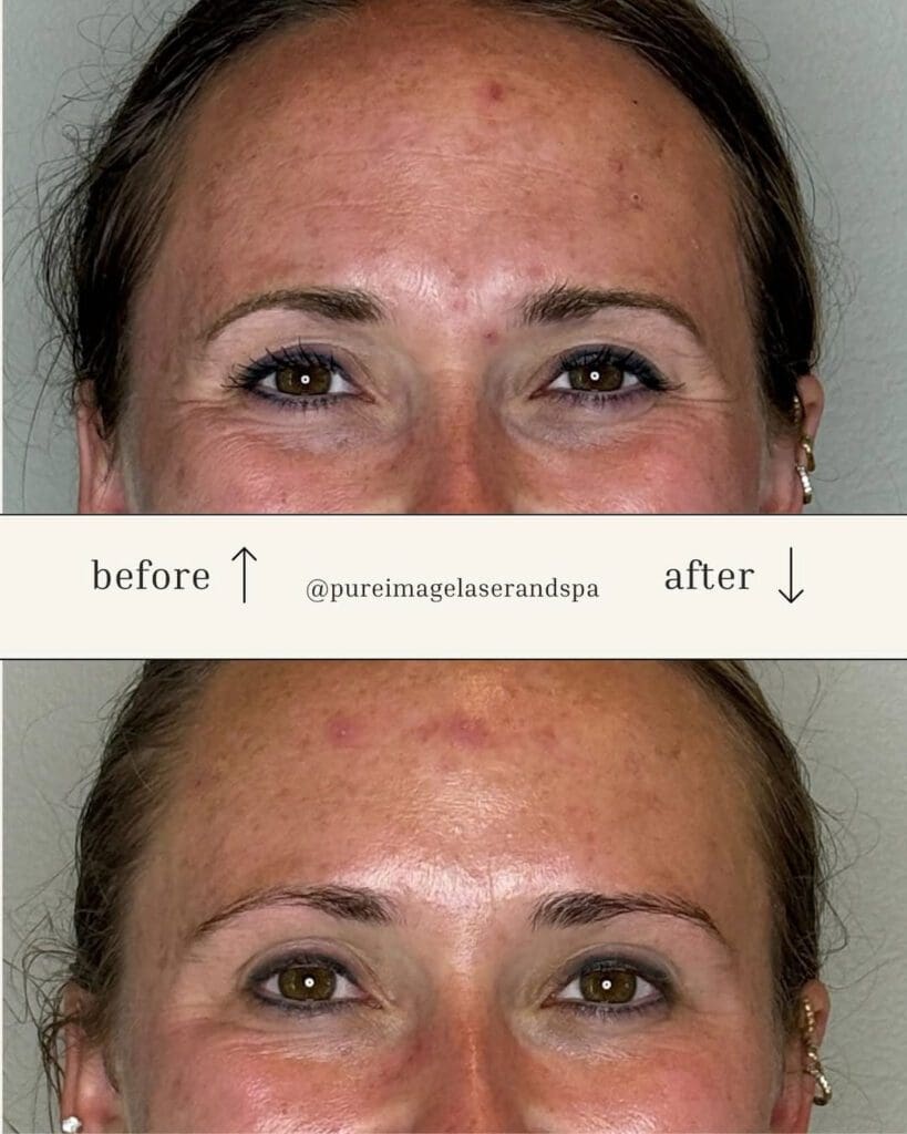Chemical Peel Treatment Indianapolis IN
