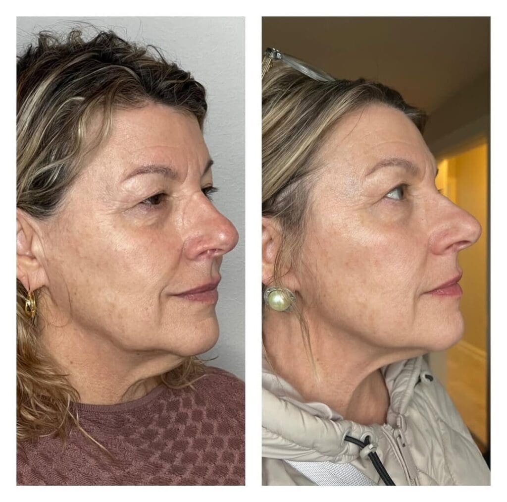 Microneedling Indianapolis