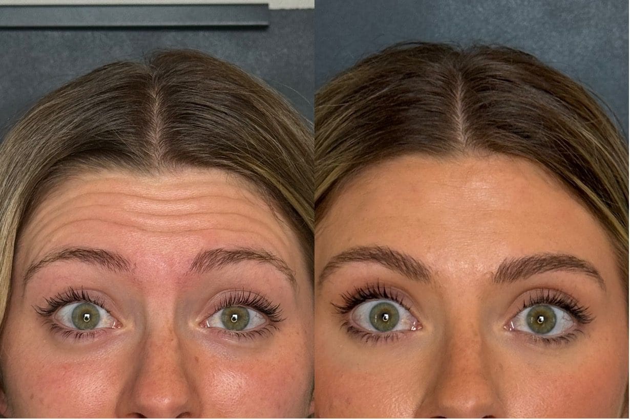 Xeomin before and after results for forehead lines and frown lines at Pure Image Laser & Spa in Indianapolis