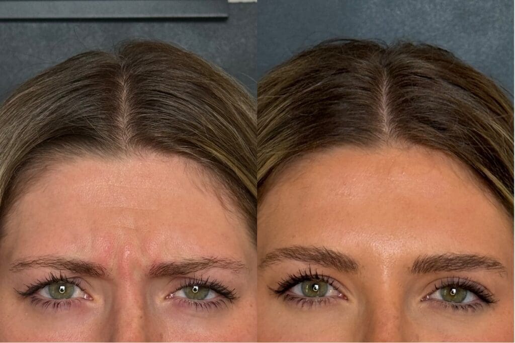 Xeomin Forehead Wrinkle Results