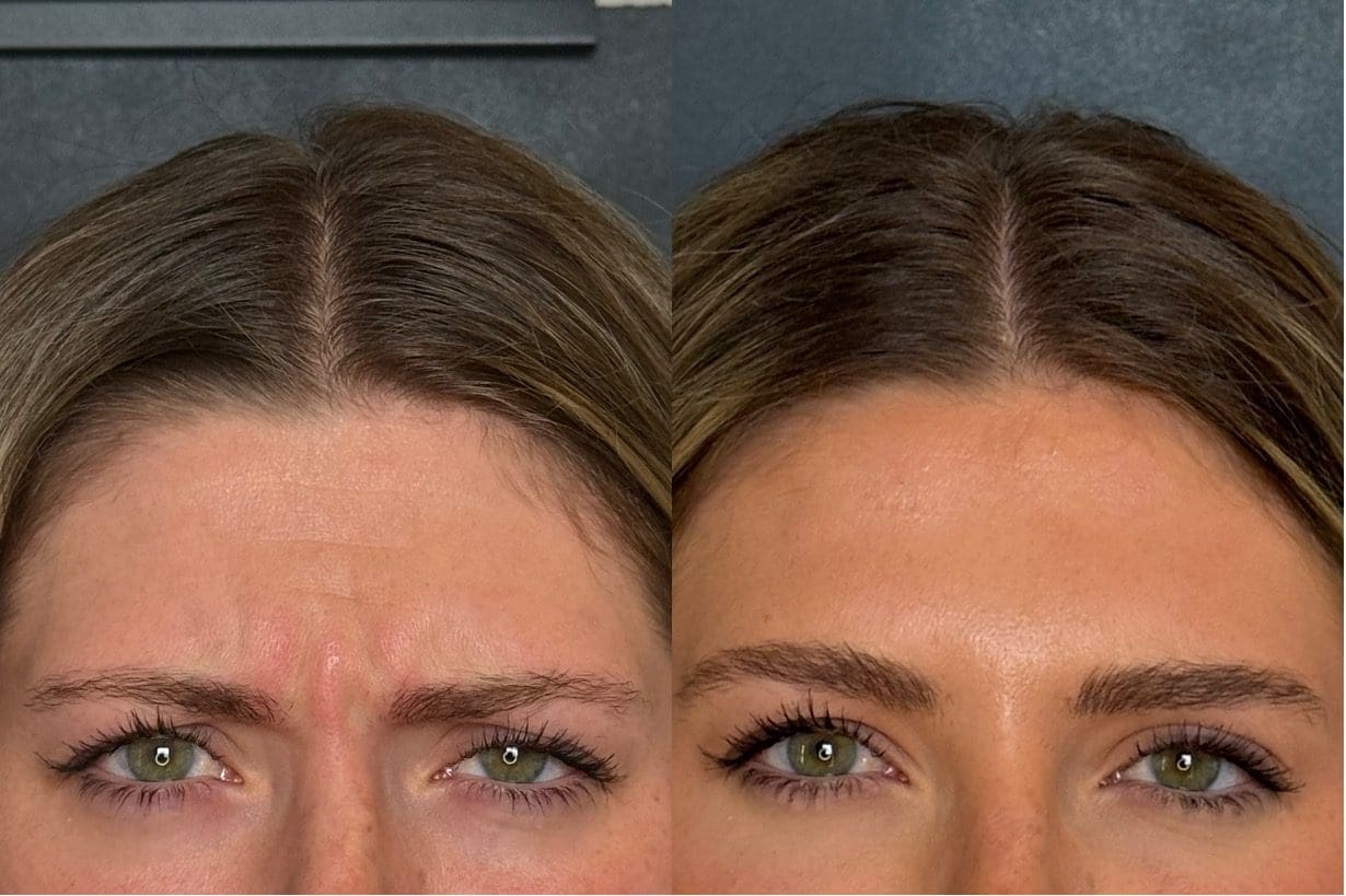 Xeomin Forehead Wrinkle Results