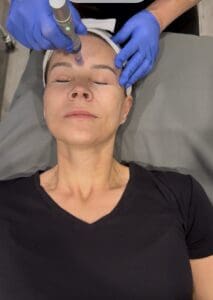 microneedling indianapolis - NexGen PDRN | VAMP | PRP | Collagen Stimulation