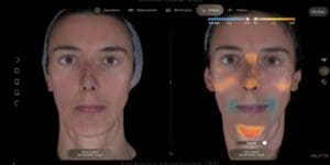 Aurora Skin Analysis